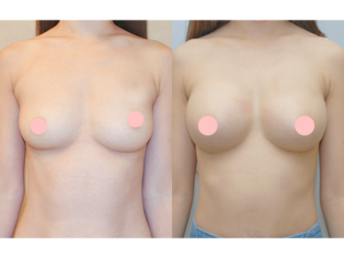 Breast Augmentation