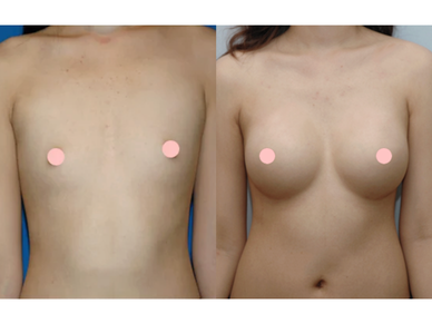 Breast Augmentation