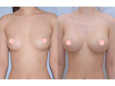 Breast Augmentation