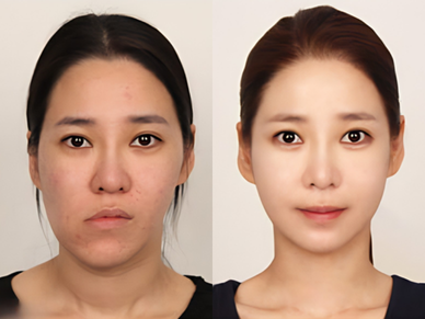 Face Contouring Surgery