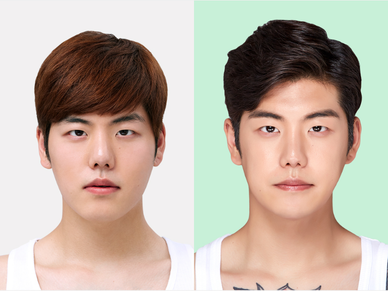 Face Contouring Surgery