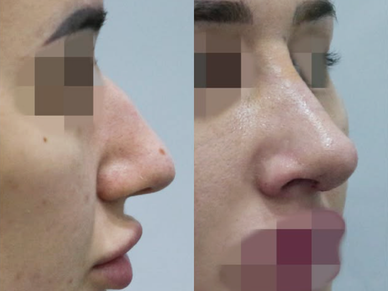 Rhinoplasty