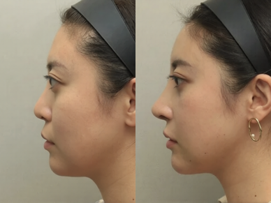 Rhinoplasty