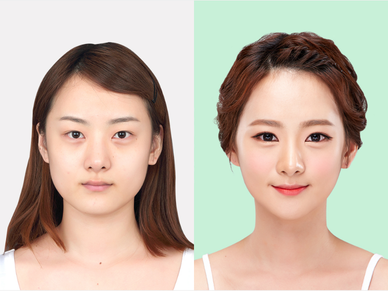 Face Contouring Surgery
