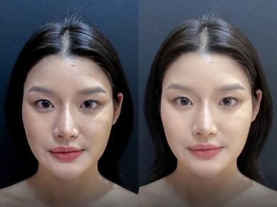 Dermal Filler