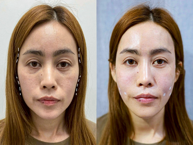 Dermal Filler