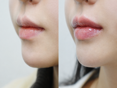 Dermal Filler