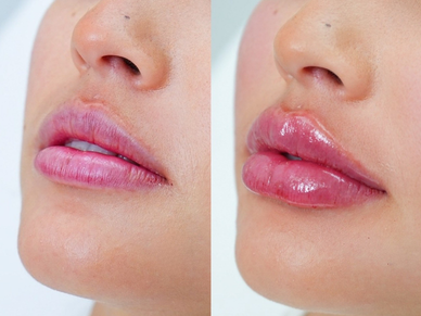 Dermal Filler