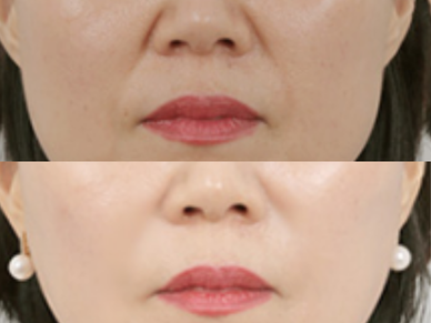 Dermal Filler