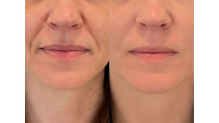 Nasolabial Folds