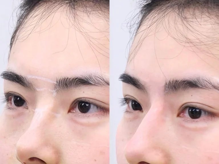 Between Brows