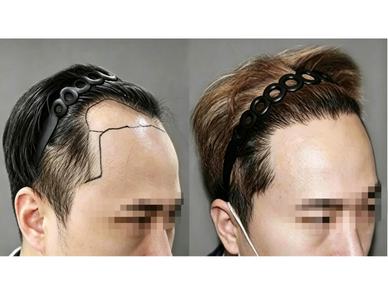 Hair Transplant