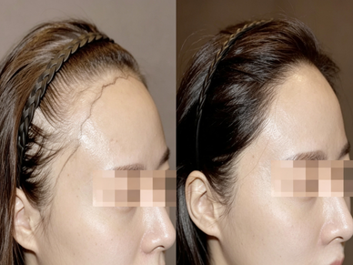 Hair Transplant