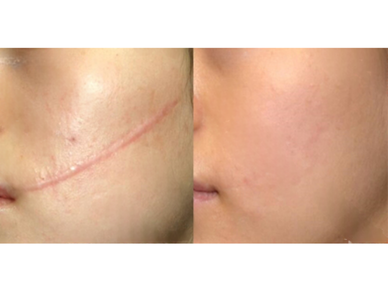 Burn Scar Reconstruction