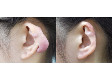Burn Scar Reconstruction