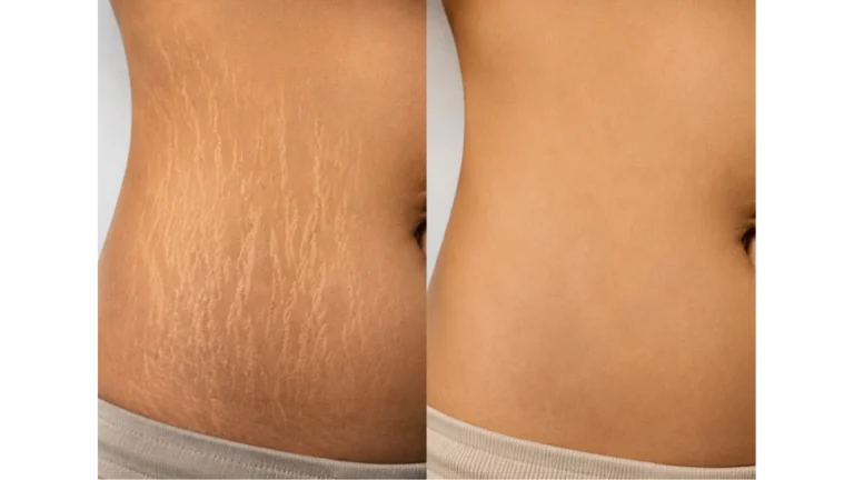 Stretch Mark