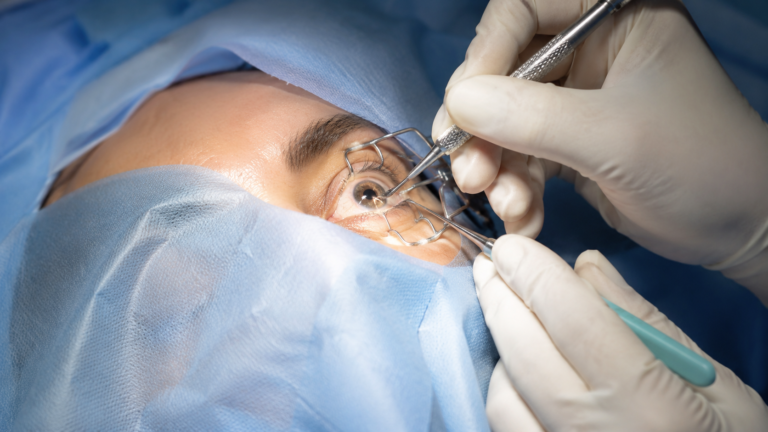 Cataract Surgery