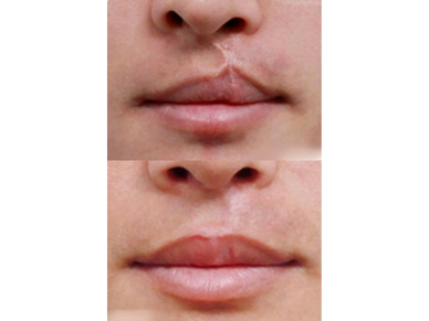 Cleft Lip
