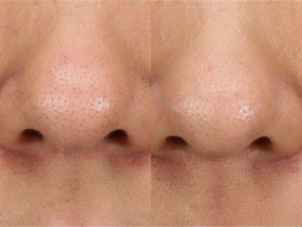 Nose
