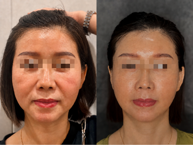 Facelift & Neck Lift