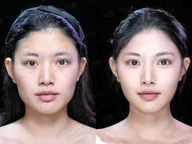 Facelift & Neck Lift