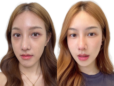 Skin Booster