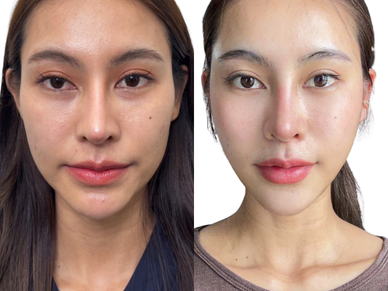 Skin Booster
