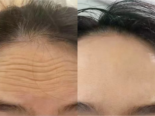 Forehead