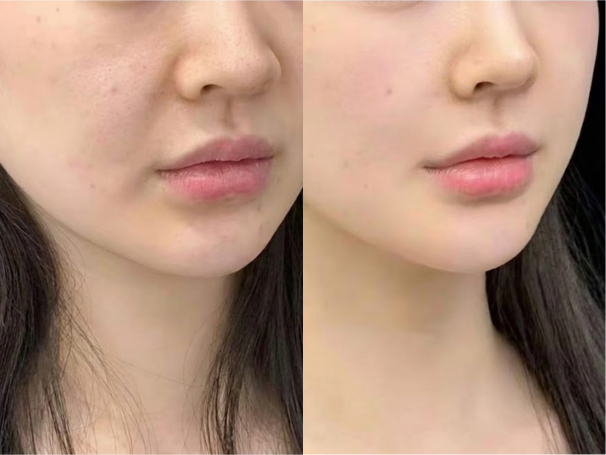 Nasolabial Folds