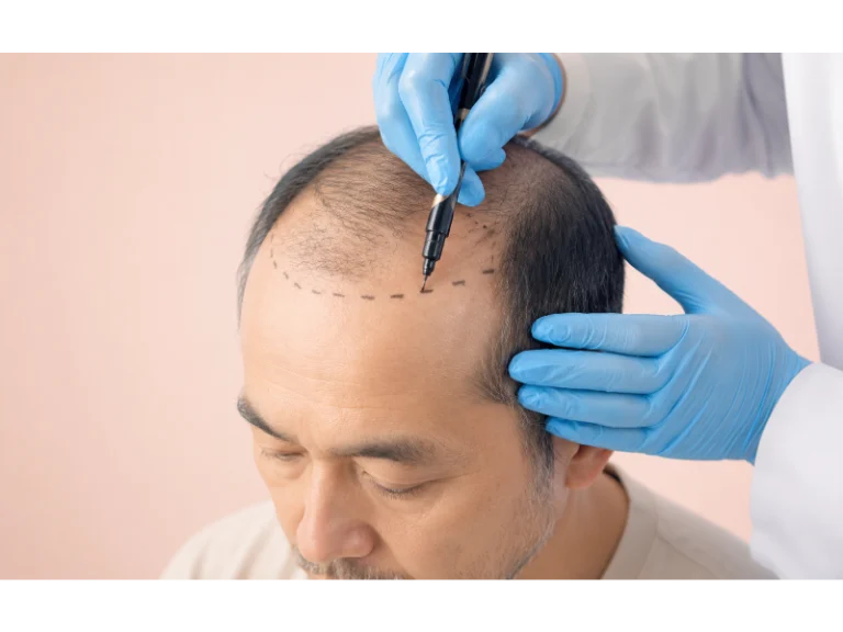 Hair Transplant
