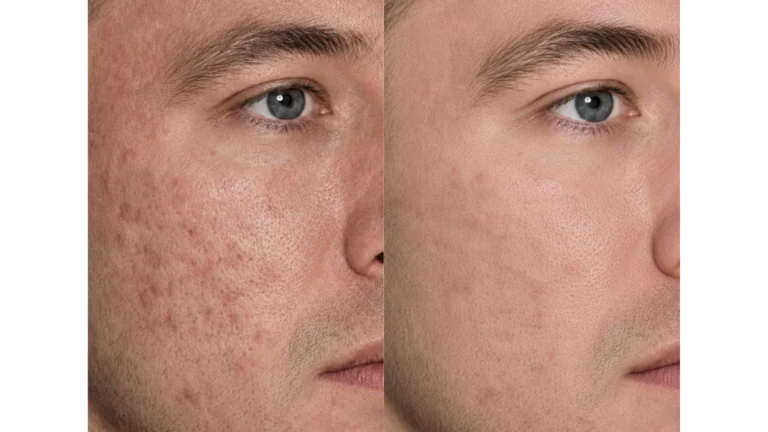 Acne Scar
