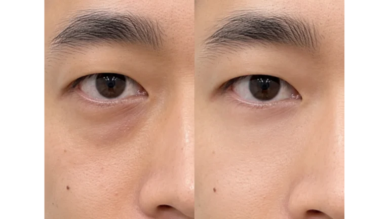 Under Eyes