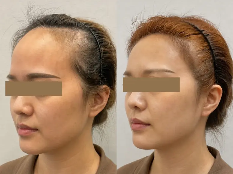 Fotona Hair Laser before and after results in Malaysia, case 3