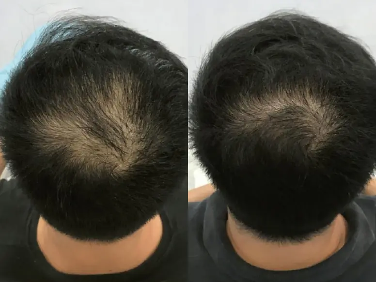 Fotona Hair Laser before and after results in Malaysia, case 1