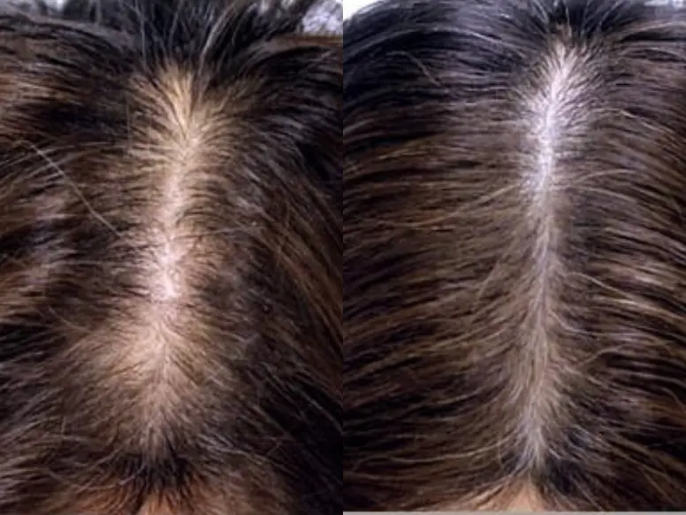 Fotona Hair Laser before and after results in Malaysia, case 2