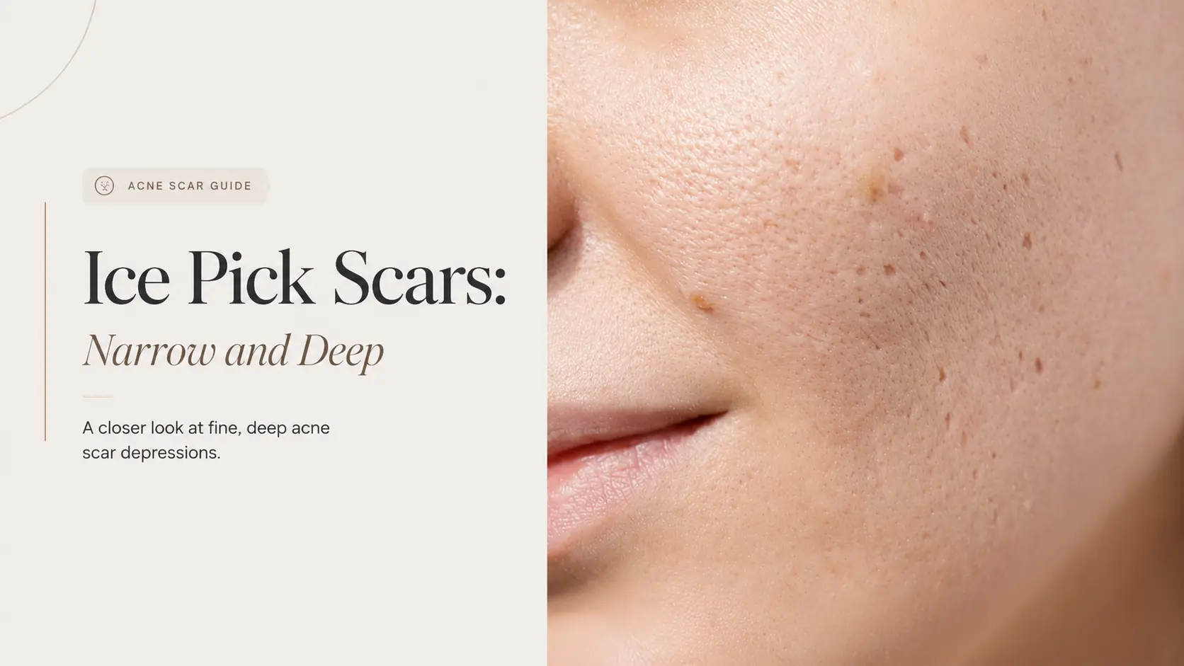 Close-up of ice pick acne scars, narrow openings that appear as small deep dots in the skin.