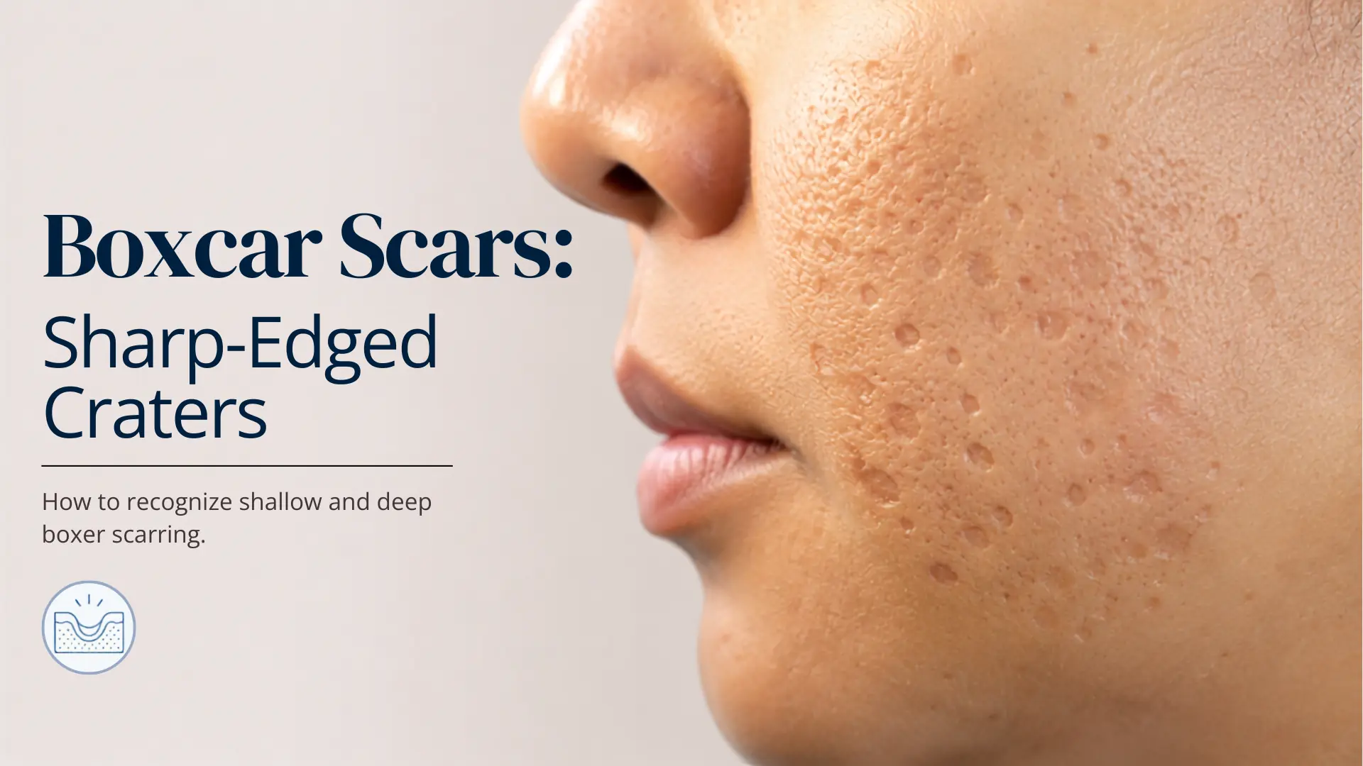 Close-up of boxcar acne scars, round depressions with sharply defined edges.