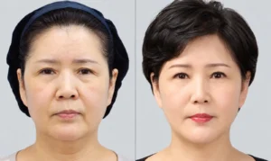 Deep plane facelift in south korea