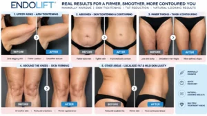 吉隆坡 Endolift 面部与身体紧致术前后案例