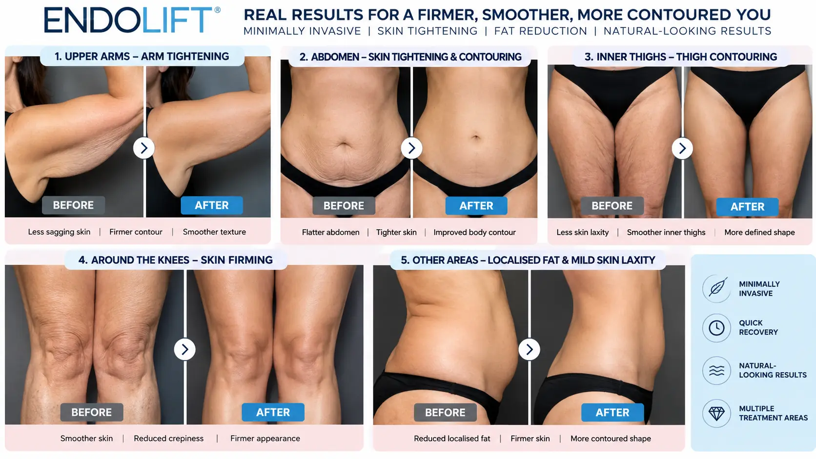 Endolift Kuala Lumpur Face and Body Tightening Before and After Case