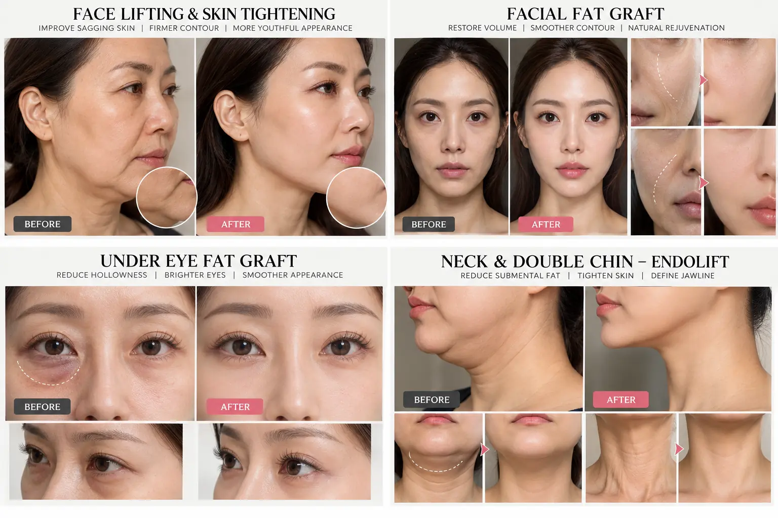 Endolift Kuala Lumpur Jawline and Lower Face Before and After Case