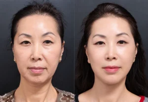 Eye Bag Removal Cost 2026