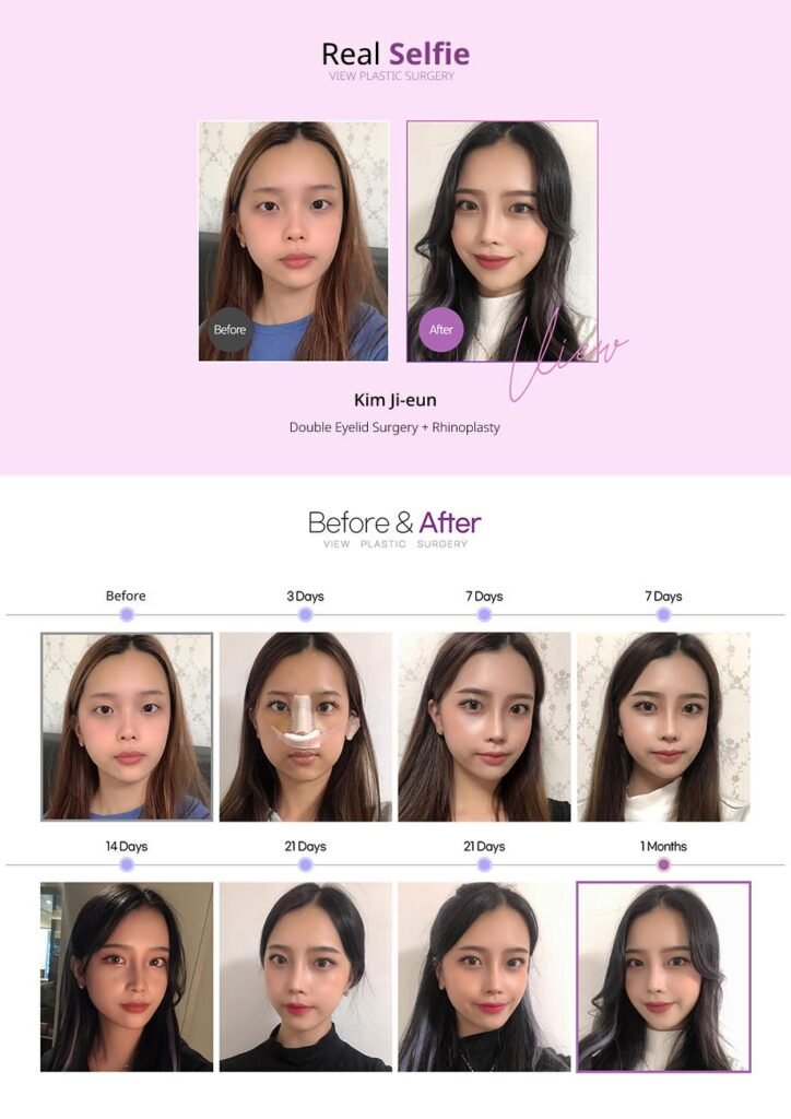 必嫵整形外科韓國雙眼皮手術前後對比效果