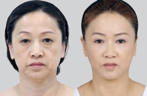 Hasil sebelum dan sesudah prosedur SMAS facelift dan pengencangan wajah di View Plastic Surgery Korea